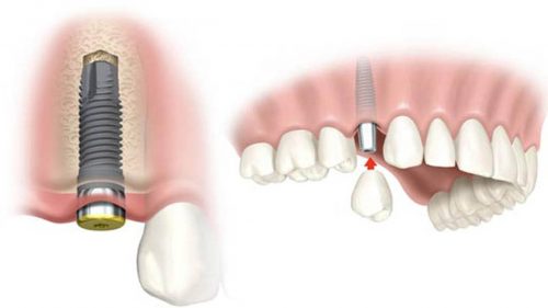 Chăm sóc răng sau cấy ghép implant 2