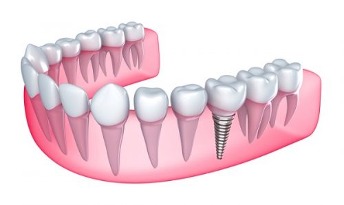 Chi phí trồng răng sứ vĩnh viễn 1