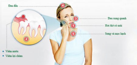 Lúc nào thì mọc răng khôn? 2