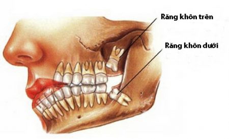 Mọc răng khôn phải làm sao thưa bác sĩ? 1