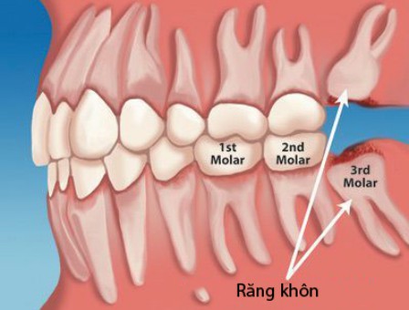 Nhổ răng khôn có đau không? 1