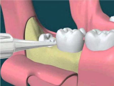 Nhổ răng khôn có đau không? 2