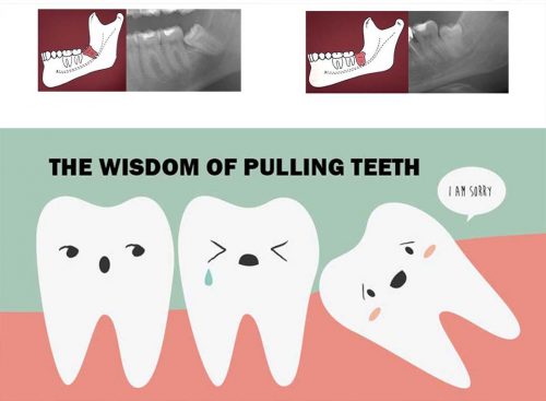 Nhổ răng khôn có nguy hiểm không? 1
