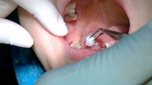Nhổ răng khôn có nguy hiểm không? 2
