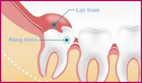 Nhổ răng khôn ở đâu tốt nhất tại Hồ Chí Minh? 1