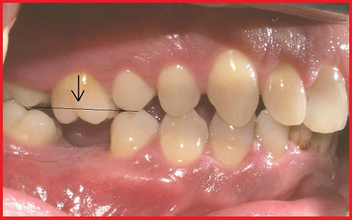Quy trình cấy ghép răng implant đạt chuẩn 2