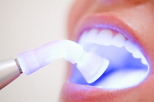 Quy trình tẩy trắng răng bằng laser như thế nào? 1