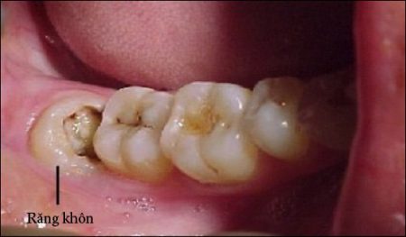 Răng khôn bị sâu có nên nhổ không? 1