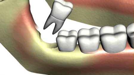 Răng khôn mọc lệch ra má phải làm sao? 2
