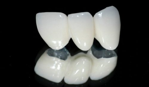 Răng sứ titan có tốt không? Hỏi đáp nha khoa 1