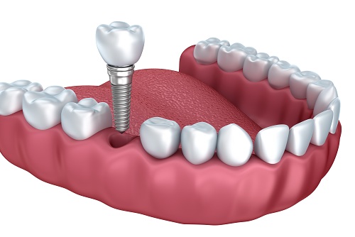 Trồng răng implant ở đâu tốt? 2