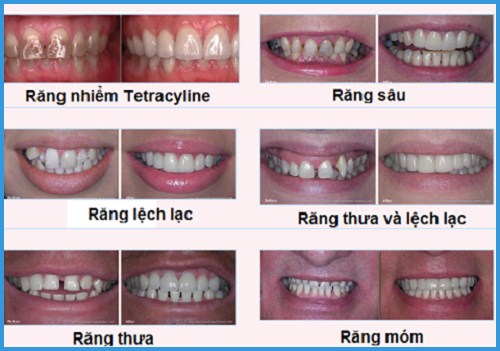 Bọc răng sứ cho răng hàm 1
