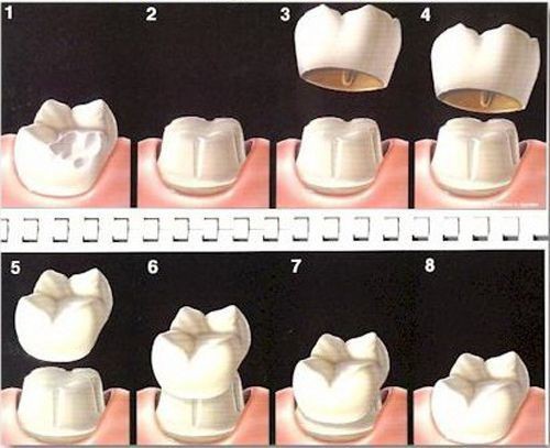 Bọc răng sứ cho răng hàm 2