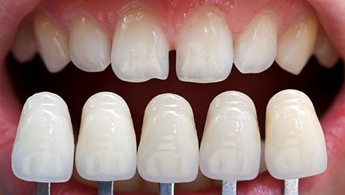 Bọc răng sứ cho răng khấp khểnh như thế nào? 2