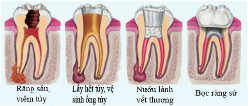 Bọc răng sứ cho răng sâu 2