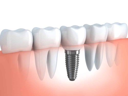 Cấy ghép trụ implant có ảnh hưởng sức khỏe không? 1