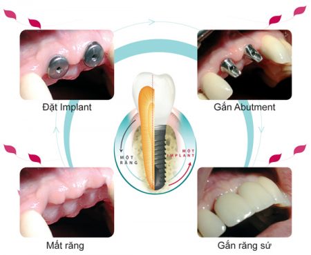 Nâng xoang hàm - Kỹ thuật hỗ trợ trong cấy ghép implant-2