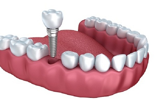 Cấy ghép răng implant như thế nào? 1