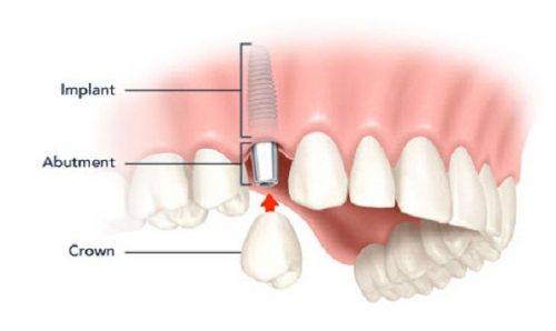 Cấy ghép răng implant như thế nào? 2