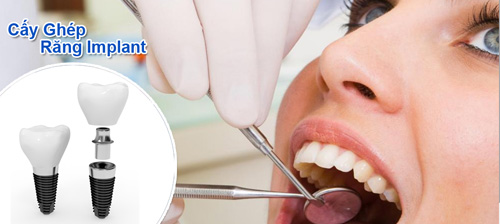 Cấy ghép răng implant như thế nào? 3
