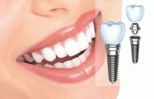Chi phí làm răng giả cố định 1
