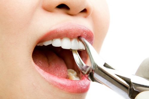 Có nên nhổ bỏ răng nanh ngầm không? 3