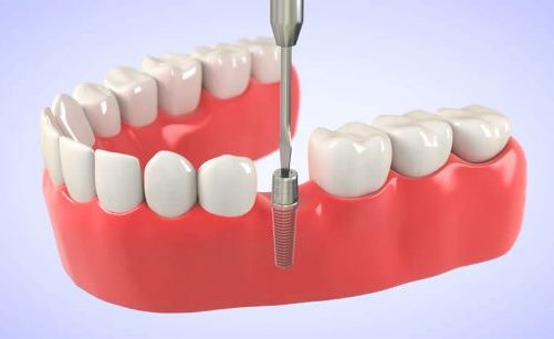 Nâng xoang hàm - Kỹ thuật hỗ trợ trong cấy ghép implant 1