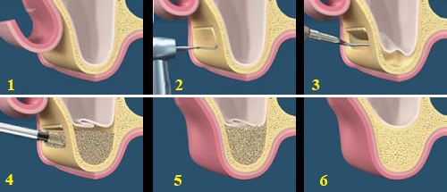 Nâng xoang hàm - Kỹ thuật hỗ trợ trong cấy ghép implant 3