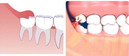Phương pháp nhổ răng khôn không đau cho bạn 2