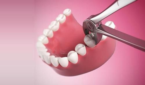 Phương pháp nhổ răng khôn không đau cho bạn 3
