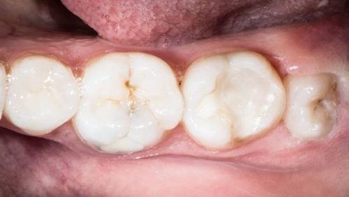 Răng khôn là gì? 2