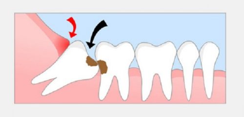 Răng khôn bị mọc lệch - Cách xử lý đúng đắn 1