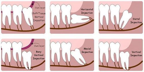 Răng khôn bị mọc lệch - Cách xử lý đúng đắn 2