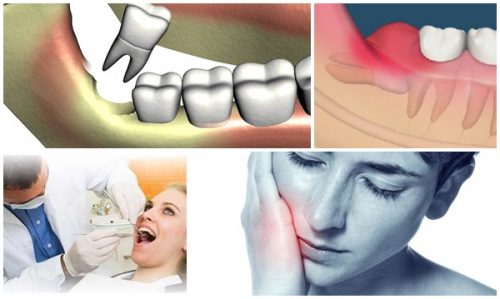 Răng khôn bị mọc lệch - Cách xử lý đúng đắn 3
