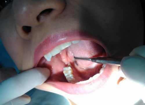 Răng khôn gồm bao nhiêu cái thưa bác sĩ? 3