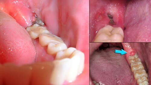 Răng khôn hàm dưới mọc lệch nên xử lý như thế nào? 2