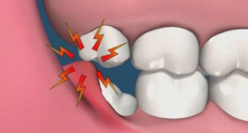 Răng khôn mọc ngầm có nên nhổ không? 2