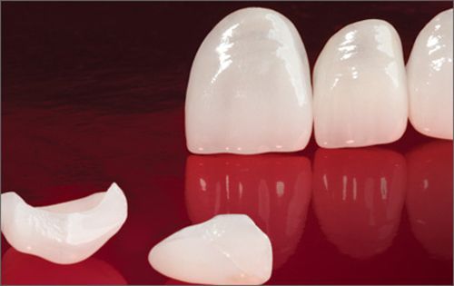 Răng sứ veneer có tốt không? 1