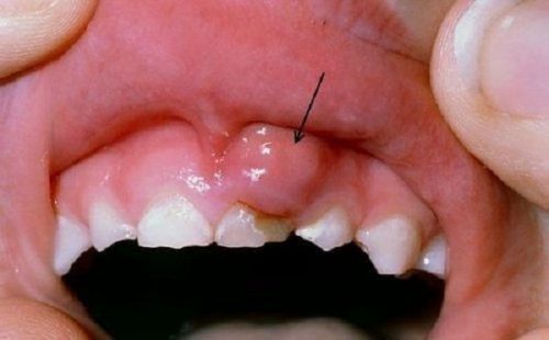 Bị viêm chân răng 1