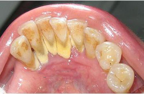 Bị viêm chân răng 2