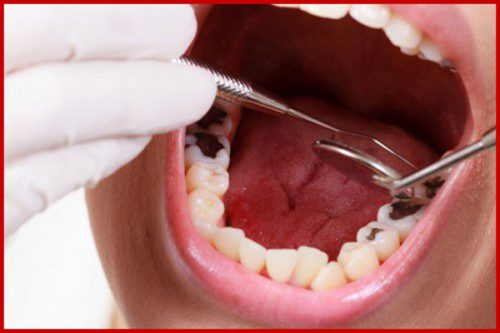 Bị viêm chân răng 3 Bị viêm chân răng 3