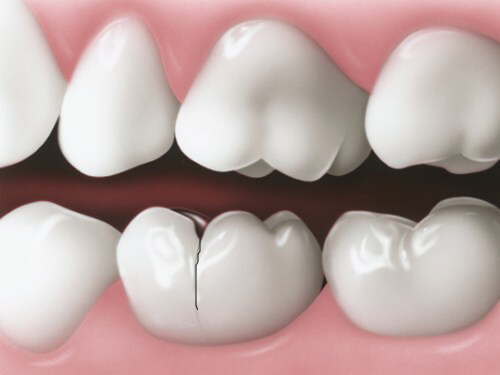 Bọc răng sứ có bị hôi miệng không? 2