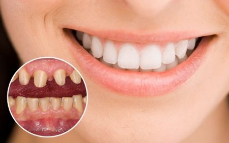 Mài bọc răng sứ có đau không? 1 Mài bọc răng sứ có đau không? 1