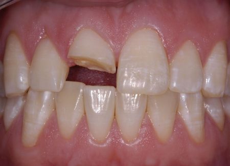 Mài bọc răng sứ có đau không? 3 Mài bọc răng sứ có đau không? 3