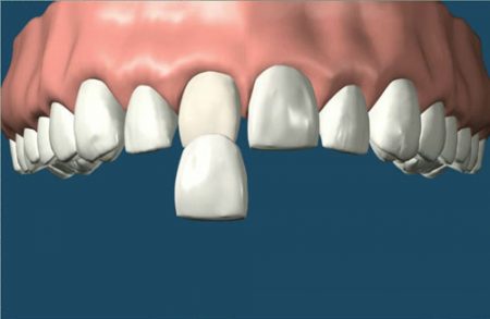 Bọc răng sứ có phải lấy tủy không - Giải đáp thắc mắc 1