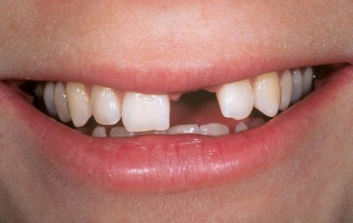 Cấy ghép implant cho răng cửa 1