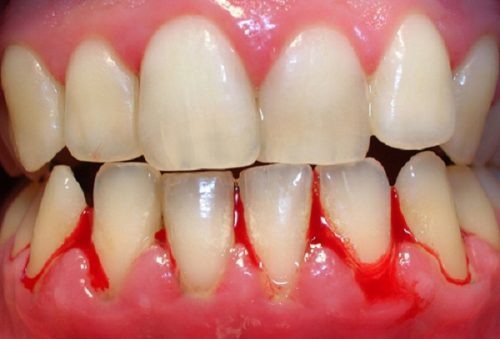 Chảy máu chân răng là biểu hiện của bệnh gì? 2