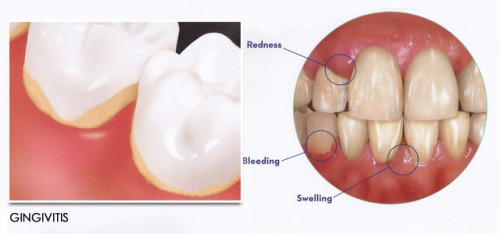 Dấu hiệu viêm chân răng 2