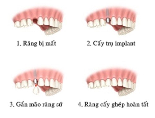 Trồng răng implant áp dụng thế nào tại nha khoa uy tín? 2