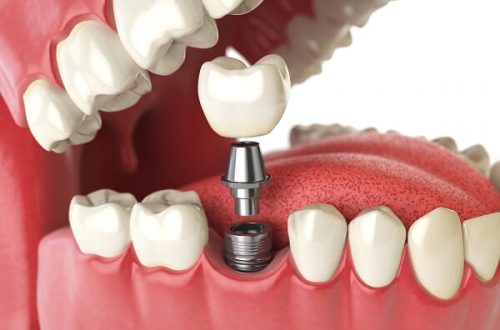 Trồng răng implant áp dụng thế nào tại nha khoa uy tín? 3